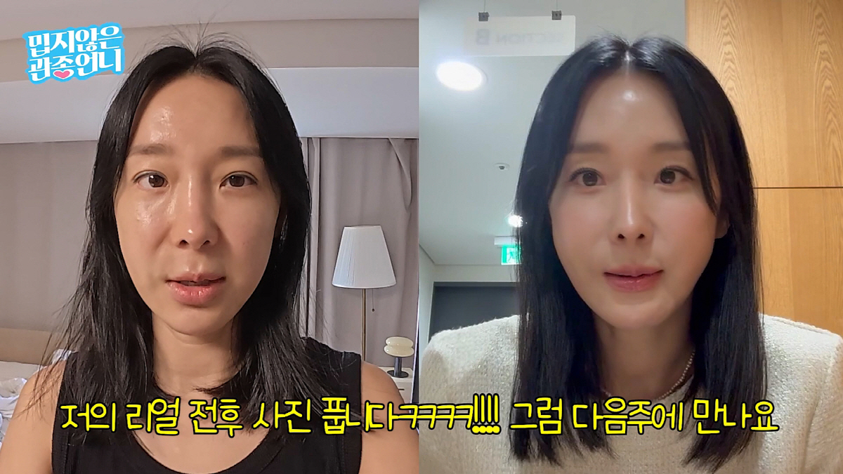 '46세' 이지혜 얼굴 성형 비포&애프터 공개…"노화 느꼈었는데 확 달라…