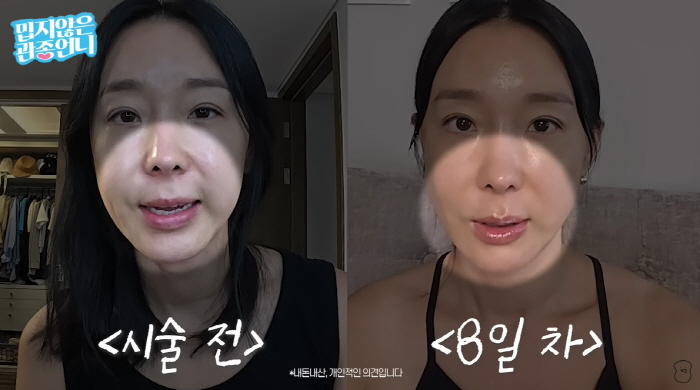 '45세' 이지혜, 실리프팅 후 얼굴 확 달라졌다...♥문재완 "진짜 예…
