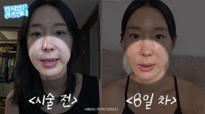 '45세' 이지혜, 실리프팅 후 얼굴 확 달라졌다...♥문재완 
