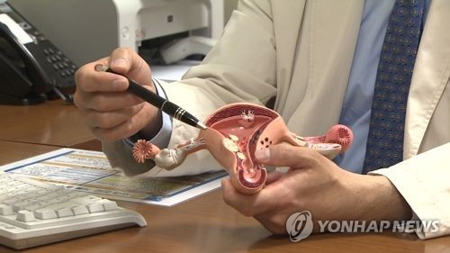 "40세 이전 조기 폐경 시 복부대동맥류 발생 위험 2배"
