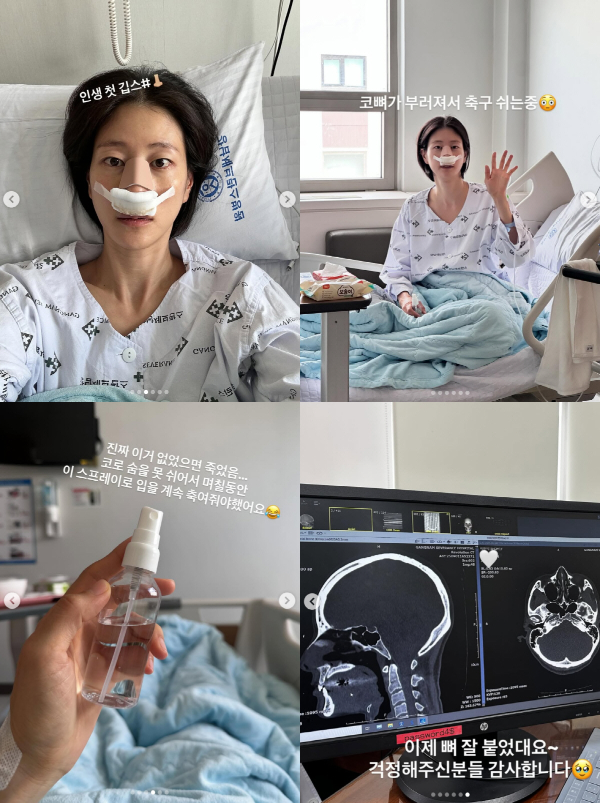 "코로 숨 안 쉬어져" 이현이, 안면마비에 코뼈 골절까지..결국 입원 치…