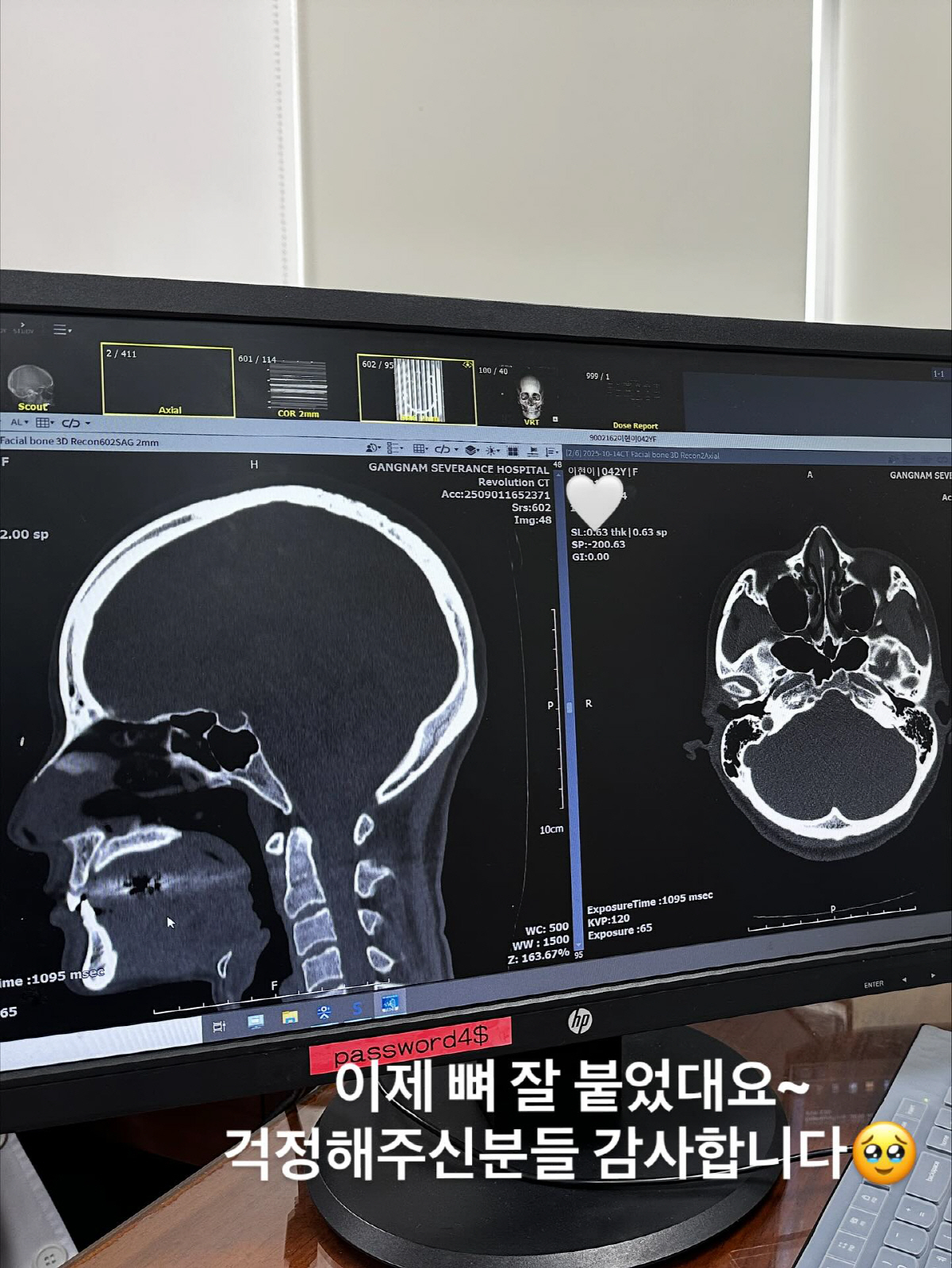 이현이, '코 수술' 실시간 공개…"예전 코로 돌아왔다"[SCin스타]