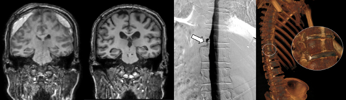 세브란스병원 '뇌척수액 정맥 누공' 진단·치료 국내 첫 성공…원인 못 찾던 뇌출혈 환자 4명 모두 쾌차