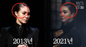 '45세' 옥주현, 모발 이식 후 심각한 부작용 