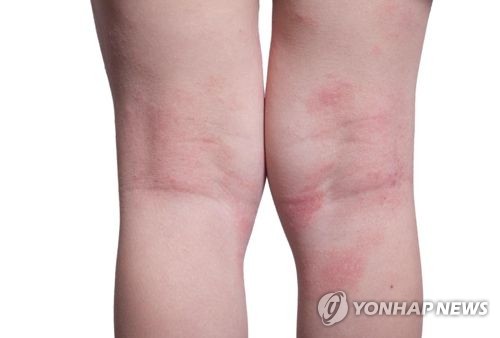 "아토피 아동, 라면·햄버거 등 먹으면 가려움 최대 2배로 증가"