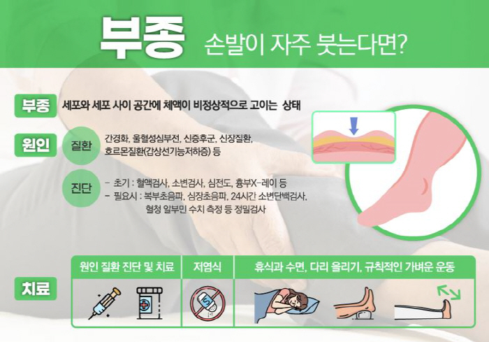 손·발이 왜 자주 붓나 했더니, '이것' 때문?