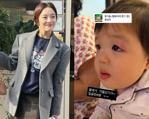 황보라 17개월子, 빨갛게 부어오른 눈두덩이..."가을 모기 얼굴만 6방…