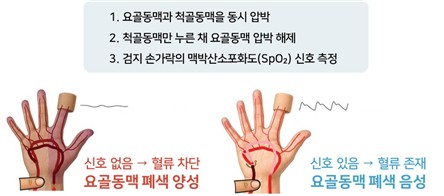 영유아 수술 후 손목 요골동맥 폐색 합병증 예방법 찾았다
