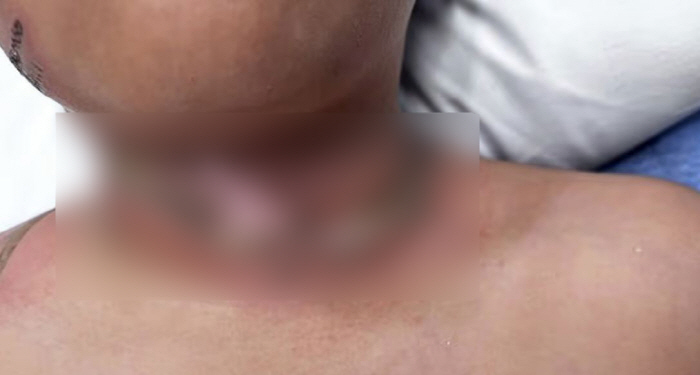 태블릿 충전 중 목걸이 감전 사고로 9살 중화상…"목숨 잃을 뻔"