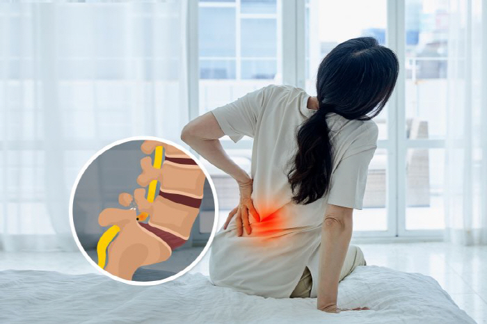 환절기 요통인 줄 알았는데…'척추분리증' 경고 신호?