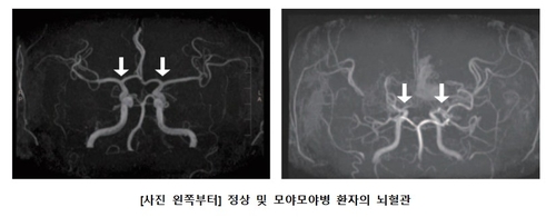 "소아 모야모야병 조기 진단 돕는 생체지표 발견"