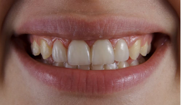 양치질해도 소용없다?…누런 치아 만드는 '5가지' 음식