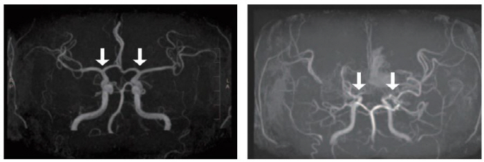 소아 모야모야병 진단·예후 예측 지표 발견…새 치료법 제시 기대