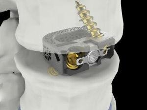 시지메드텍, 척추 임플란트 '유니스페이스' FDA 승인
