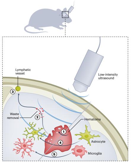 [사이테크+] "초음파로 뇌졸중 쥐의 뇌 노폐물 제거…치매 등 치료 기대"