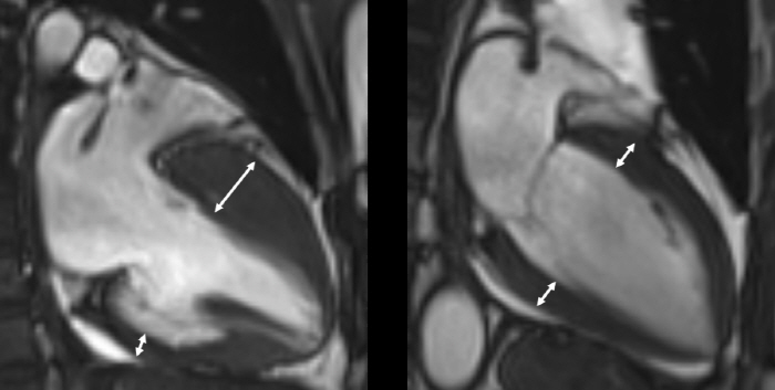 돌연사 위험 '조용한' 비후성 심근병증, 평상시 대처는?