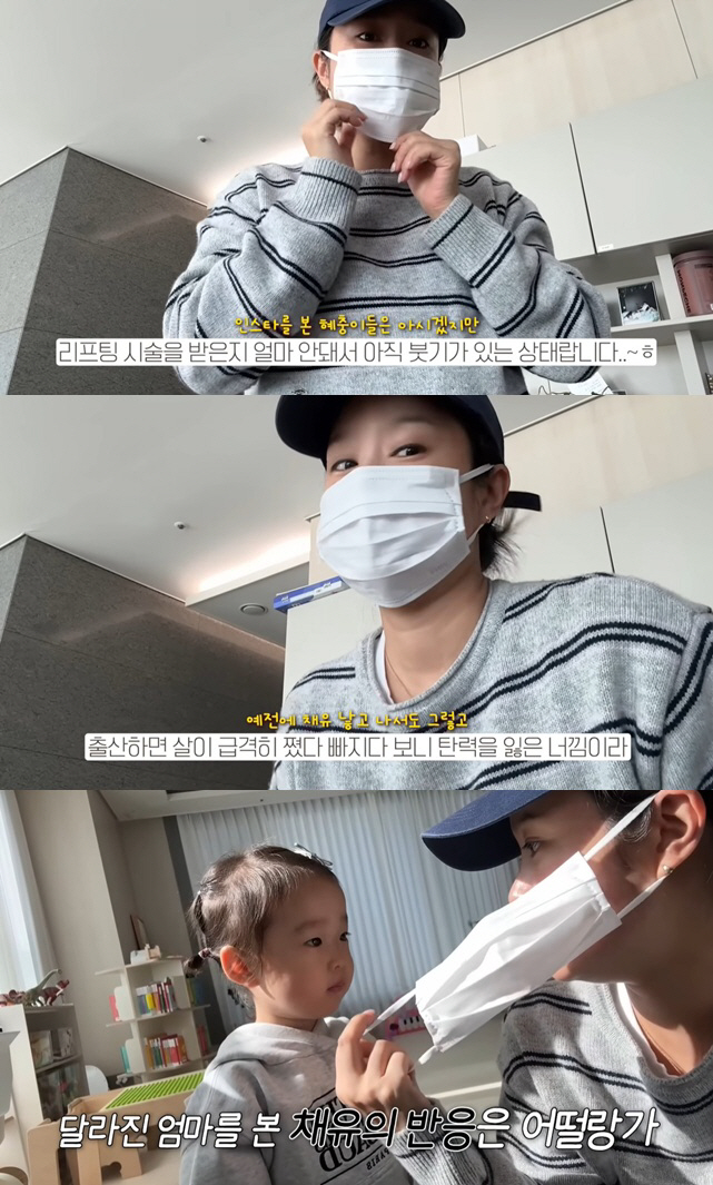 헤이지니, 둘째 출산 후 퉁퉁 부은 얼굴 "리프팅 시술 부기 때문"