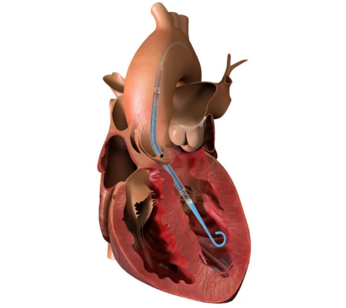 심인성 쇼크, 원내 사망률 최대 '50%'…'치료 옵션' 초소형 인공심장펌프 임펠라 국내 공식 출시