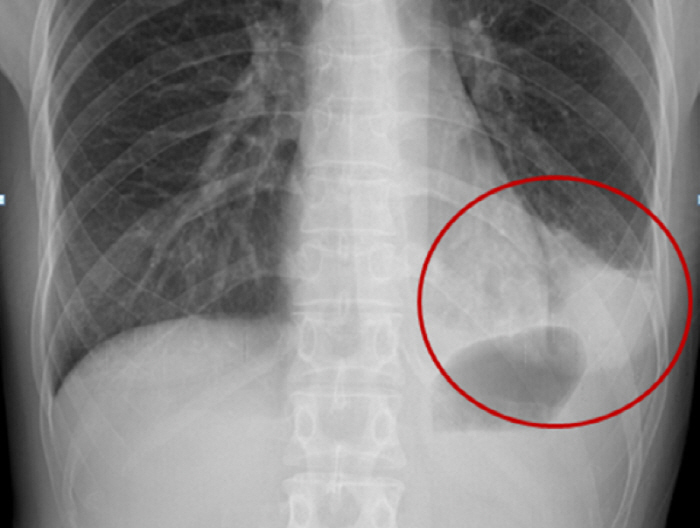 환절기·겨울철 폐렴 주의보…고령층 치명적 예방 접종 중요