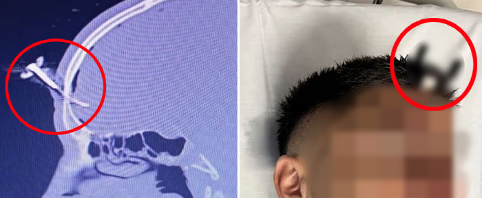 딸 축구 경기 중 폭력 사태 휘말려, 아빠 머리에 차 열쇠 박혀