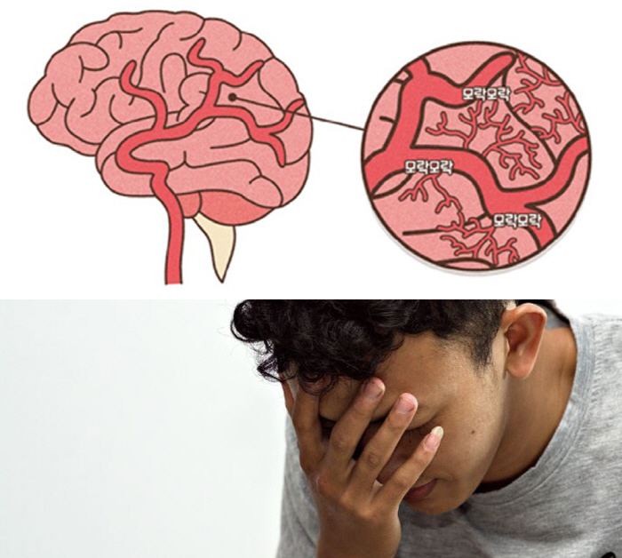 두통·팔다리 마비 반복되는 소아·30대·40대 '모야모야병' 의심