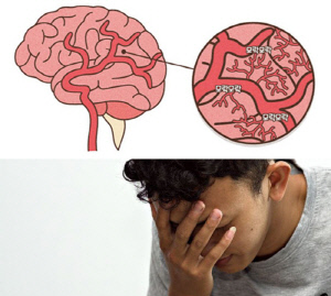 두통·팔다리 마비 반복되는 소아·30대·40대 '모야모야병' 의심