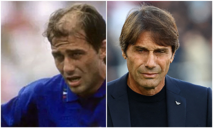 "토트넘 탈모라인,머리숱 자신감 장착!" 세계 최대 튀르키예 모발이식 클…