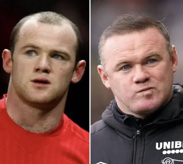 "토트넘 탈모라인,머리숱 자신감 장착!" 세계 최대 튀르키예 모발이식 클…