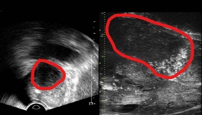 분당서울대병원, 전립선 종양 평가 가능한 '마이크로 초음파' 첫 도입…기…