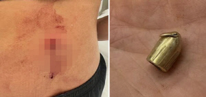 미녀 배구 스타, 강도가 쏜 총 등에 맞아…몇 ㎜ 차이로 생존 