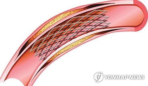 [건강포커스] "당뇨병 환자, 스텐트 시술 합병증 위험 최대 2배 이상 높아"