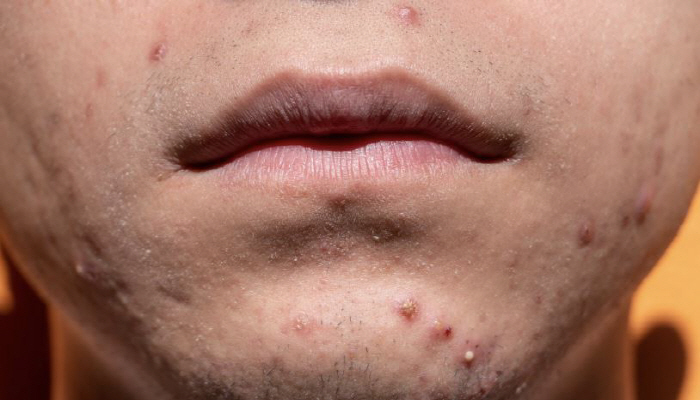 여드름 짰을 뿐인데 폐 질환 발병, 이유 알고 보니…