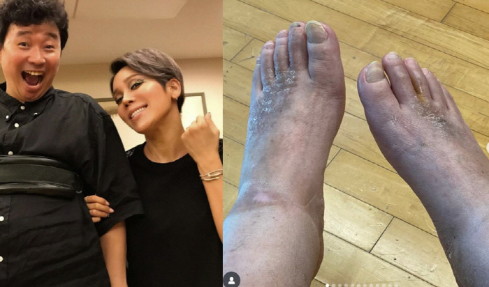 김송, '하반신 마비' ♥강원래 발 상태 공개… "발톱 빠져도 감각 없다…