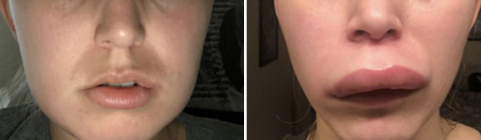 진단까지 평균 8년 걸리는 '유전성 혈관부종'을 아시나요?