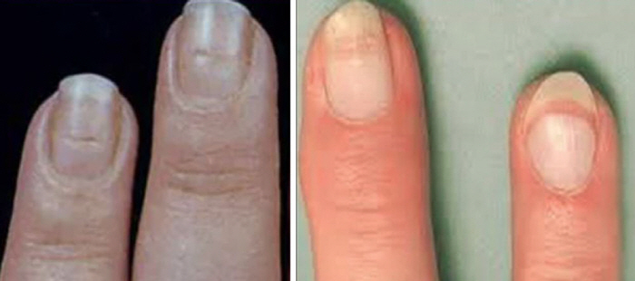 몸이 보내는 질환 '경고 신호'…귓불·손톱에 이러 변화가?