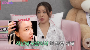 배윤정, 심각한 M자 탈모에 모발 이식 