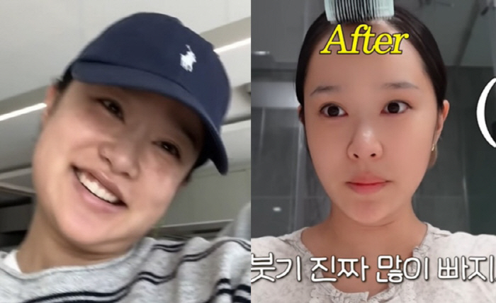 헤이지니, 리프팅 시술 한달만 '얼굴 확 변했다'..V라인 턱선에 '깜짝'