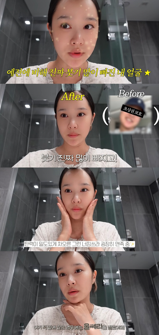 헤이지니, 리프팅 시술 한달만 '얼굴 확 변했다'..V라인 턱선에 '깜짝…