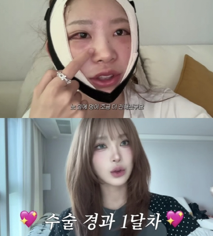 '최진실 딸' 최준희, 또 성형했다..붉게 멍든 눈 리얼 공개 "부기 덜…