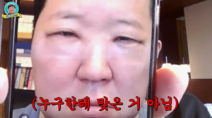 정형돈, 성형 직후 퉁퉁 부은 눈 공개 