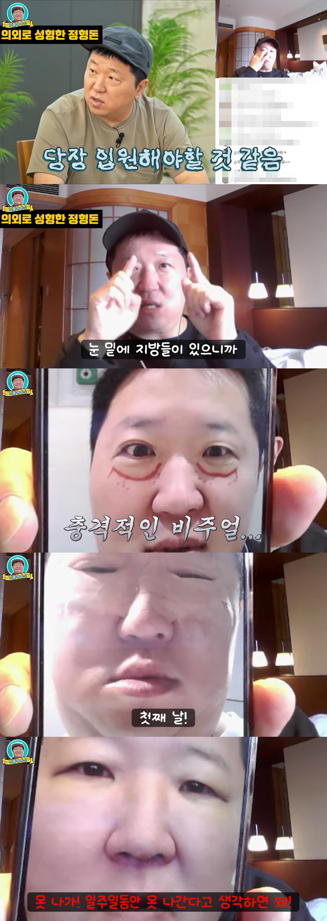 정형돈, 성형 직후 퉁퉁 부은 눈 공개 "일주일 동안 못 나가"