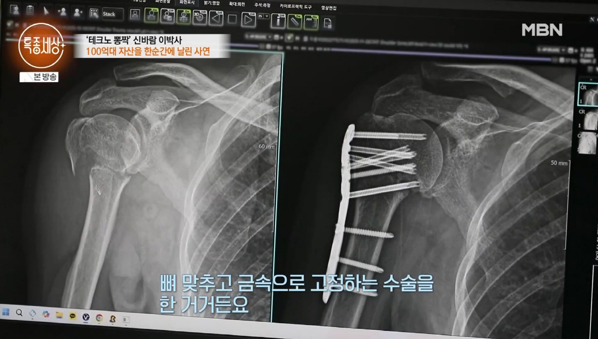 '100억 자산가' 이박사, '불의의 사고' 후 안타까운 근황..."팔 …