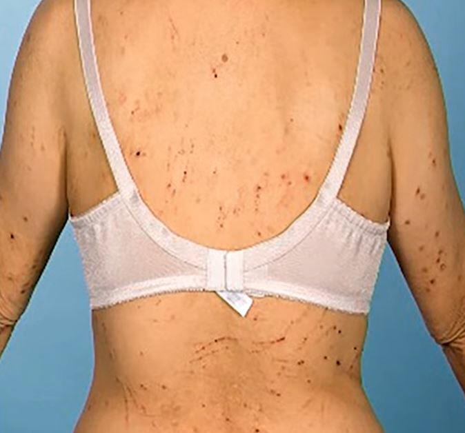 항암 중 피부·모발·손발톱 변화…대처법과 회복 시기는?