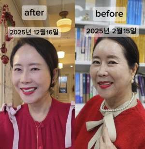 '63세' 윤영미, 9kg 감량→안면·목거상 후 달라진 얼굴 