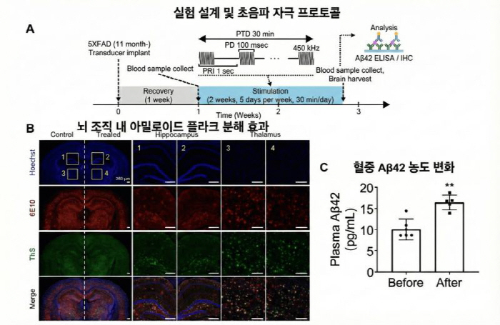 "약물 없이 초음파로 알츠하이머 원인 물질 65% 제거"
