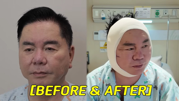 67세 심형래, 성형후 퉁퉁 부은 얼굴..안면거상 비포·애프터 공개