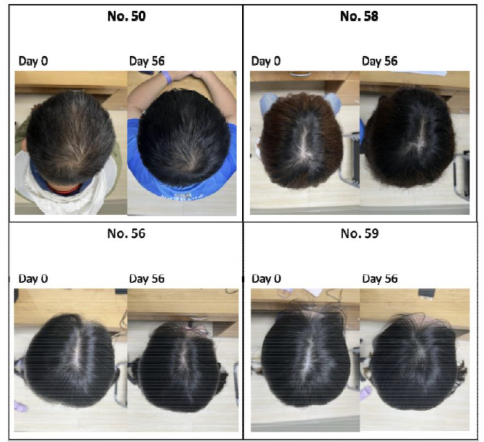 머리에 '이것' 발랐더니 모발 굵기·밀도 2배 증가…탈모 치료 가능성 제…