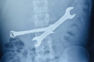 뱃속에서 발견된 칫솔 7개·스패너 2개…