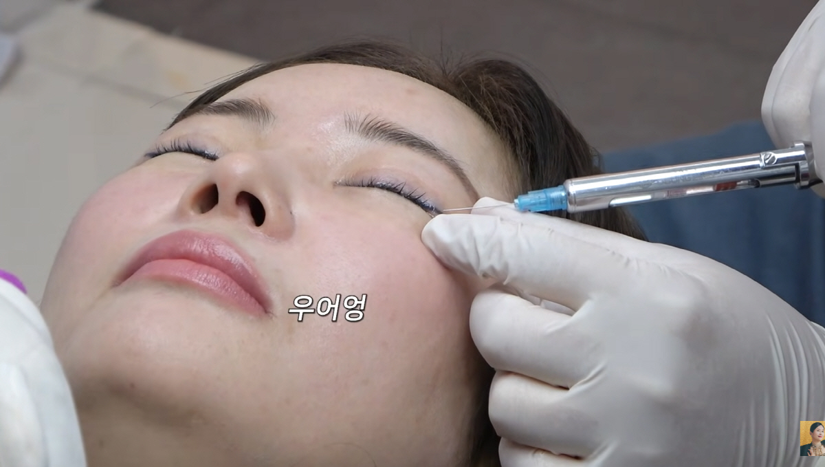 "얼굴까지 밟혔다"…장영란, '48세 리즈'찍기 위해 받은 최신 시술 A…