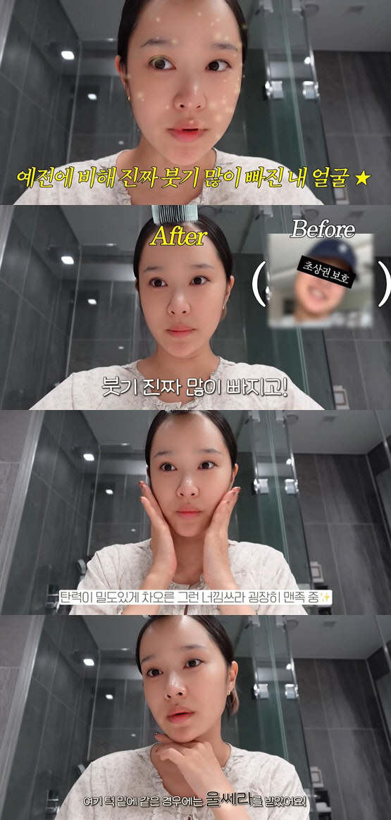 헤이지니, 리프팅 시술+모발이식후 확 달라진 비주얼 "너무 만족스러워"